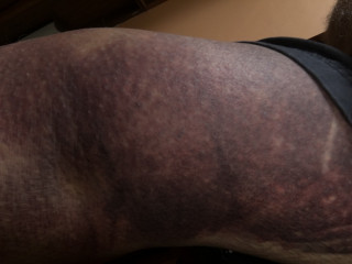 Inside of right knee, black and blue.